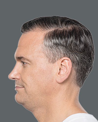 Double Chin Reduction with Kybella Before & After Gallery - Patient 187998 - Image 1