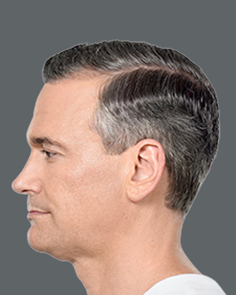 Double Chin Reduction with Kybella Before & After Gallery - Patient 187998 - Image 2