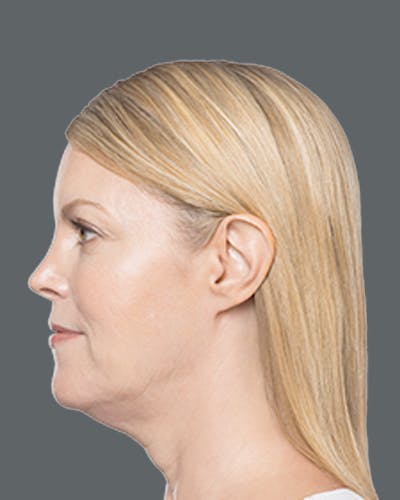 Double Chin Reduction with Kybella Before & After Gallery - Patient 229464 - Image 1