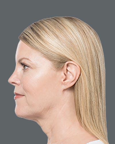 Double Chin Reduction with Kybella Before & After Gallery - Patient 229464 - Image 2