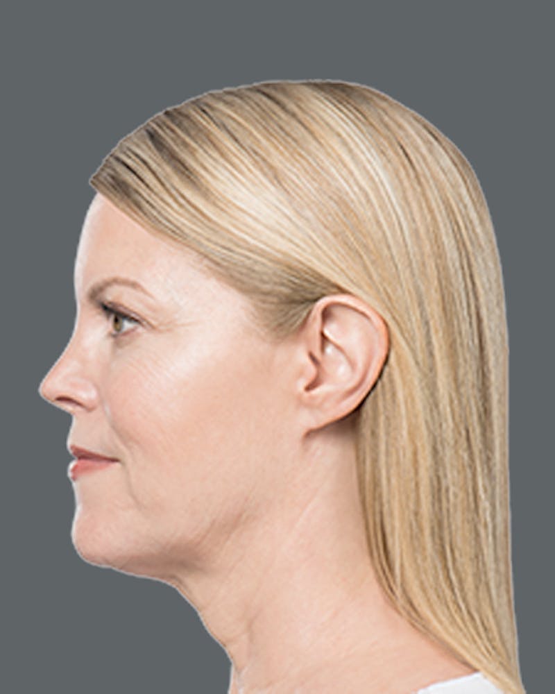Double Chin Reduction with Kybella Before & After Gallery - Patient 229464 - Image 2