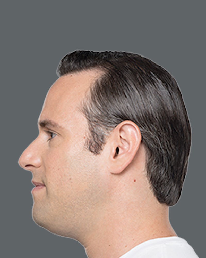 Double Chin Reduction with Kybella Before & After Gallery - Patient 417047 - Image 1