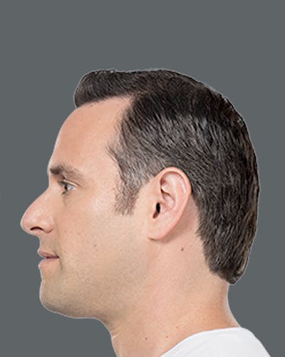 Double Chin Reduction with Kybella Before & After Gallery - Patient 417047 - Image 2