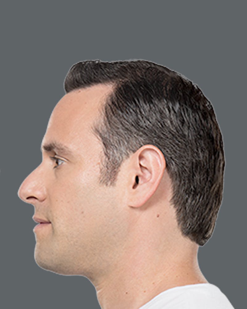 Double Chin Reduction with Kybella Before & After Gallery - Patient 417047 - Image 2