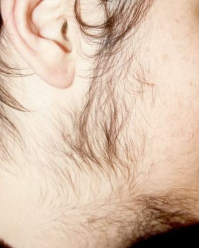 Electrolysis Hair Removal Before & After Gallery - Patient 140460 - Image 1