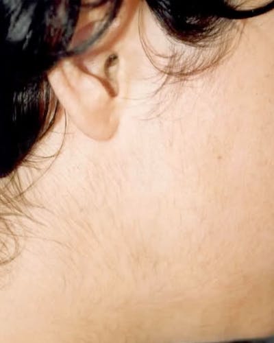 Electrolysis Hair Removal Before & After Gallery - Patient 140460 - Image 2