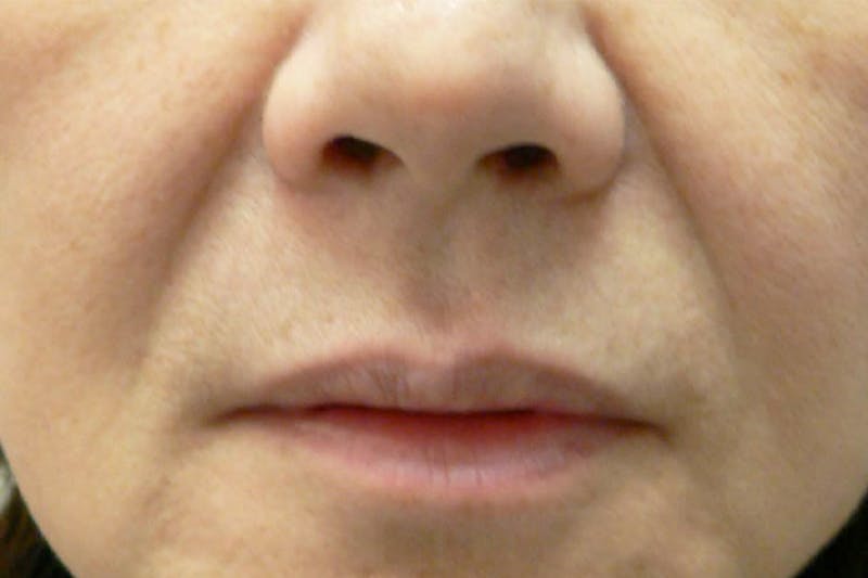 Fillers for Wrinkles Before & After Gallery - Patient 255516 - Image 1