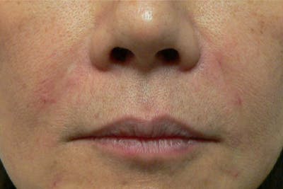 Fillers for Wrinkles Before & After Gallery - Patient 255516 - Image 2