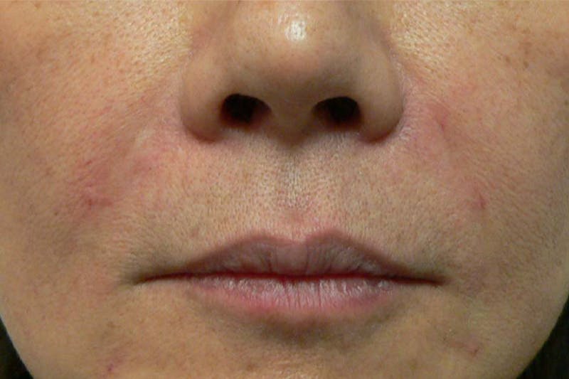 Fillers for Wrinkles Before & After Gallery - Patient 255516 - Image 2