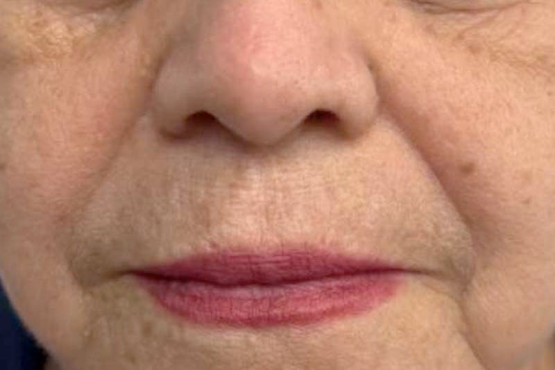 Fillers for Wrinkles Before & After Gallery - Patient 240121 - Image 1