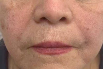 Fillers for Wrinkles Before & After Gallery - Patient 240121 - Image 2