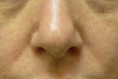 Fillers for Wrinkles Before & After Gallery - Patient 176762 - Image 1