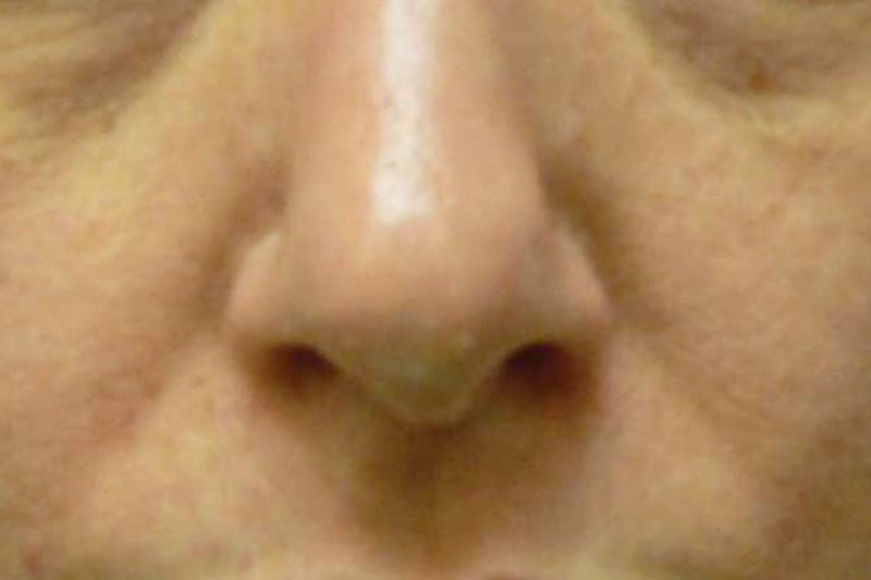 Fillers for Wrinkles Before & After Gallery - Patient 176762 - Image 1