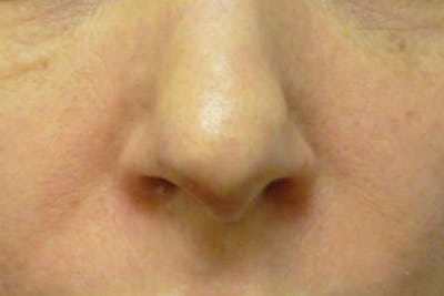 Fillers for Wrinkles Before & After Gallery - Patient 176762 - Image 2