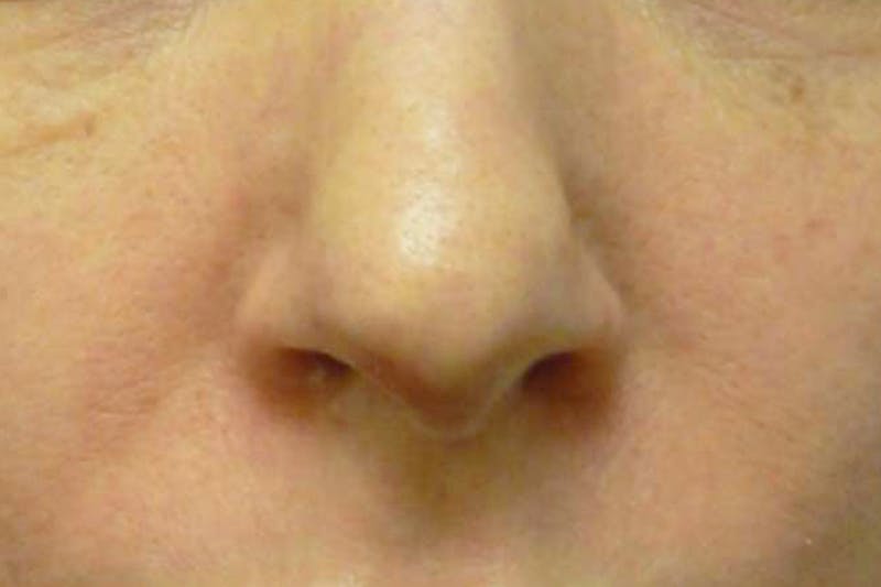 Fillers for Wrinkles Before & After Gallery - Patient 176762 - Image 2
