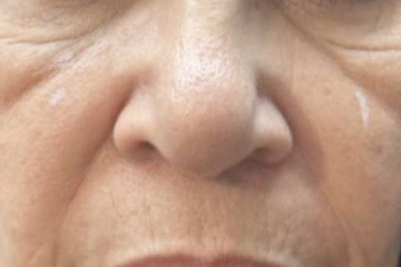 Fillers for Wrinkles Before & After Gallery - Patient 112544 - Image 1
