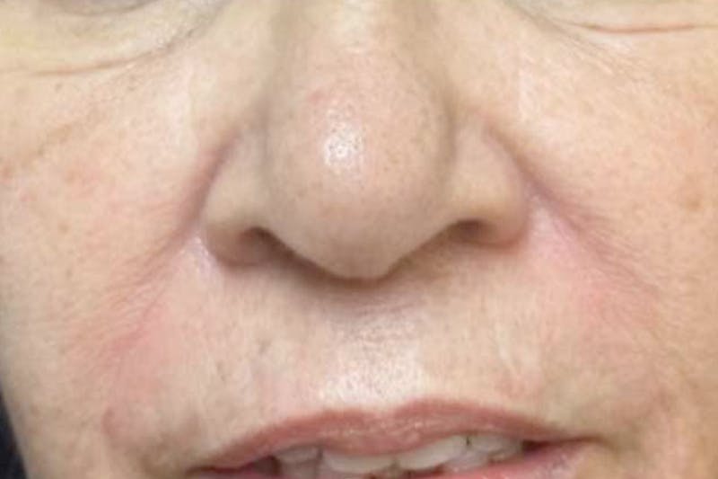 Fillers for Wrinkles Before & After Gallery - Patient 112544 - Image 2
