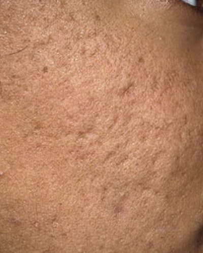 Fraxel Before & After Gallery - Patient 365859 - Image 1