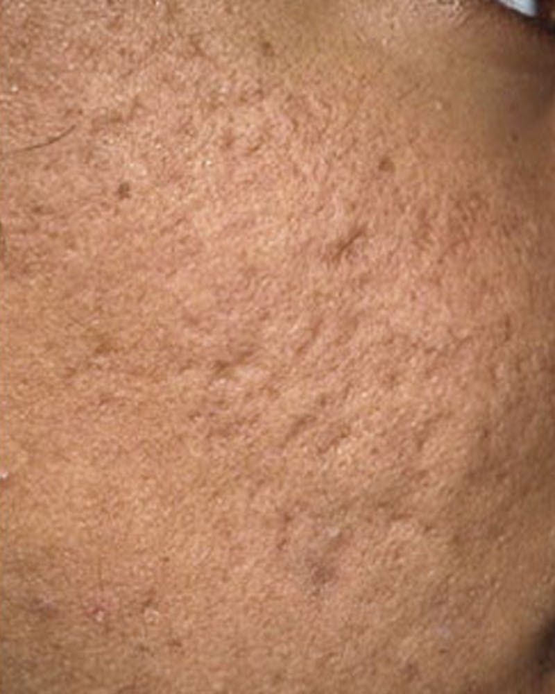Fraxel Before & After Gallery - Patient 365859 - Image 1
