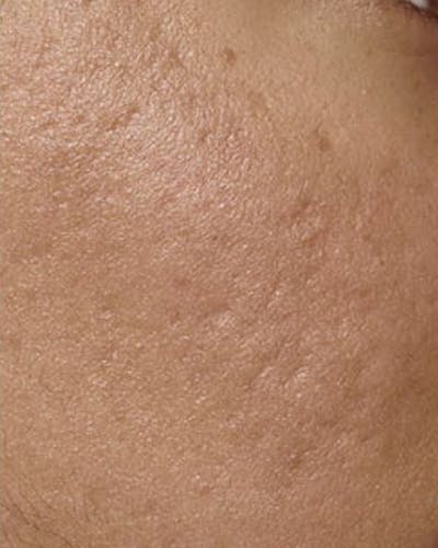 Fraxel Before & After Gallery - Patient 365859 - Image 2