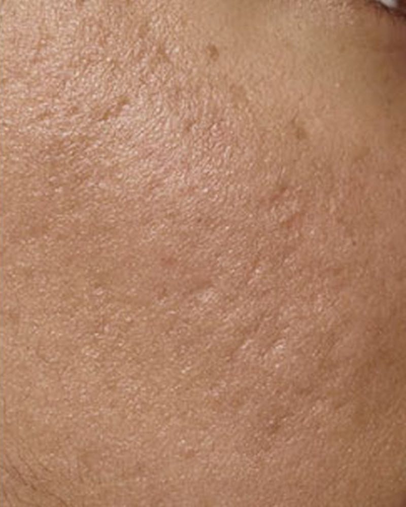 Fraxel Before & After Gallery - Patient 365859 - Image 2