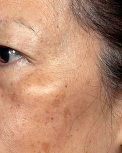 Fraxel Before & After Gallery - Patient 424301 - Image 1