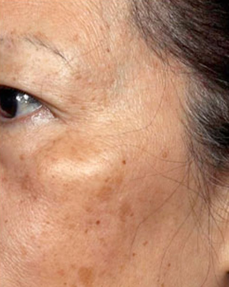 Fraxel Before & After Gallery - Patient 424301 - Image 1