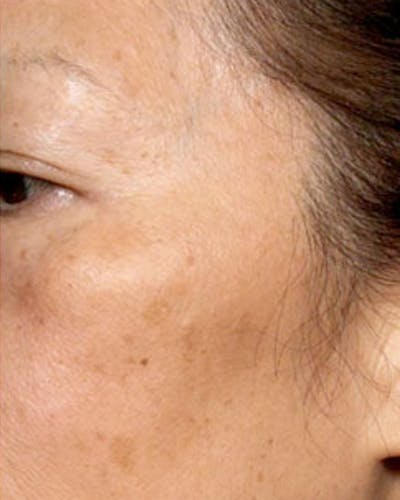 Fraxel Before & After Gallery - Patient 424301 - Image 2