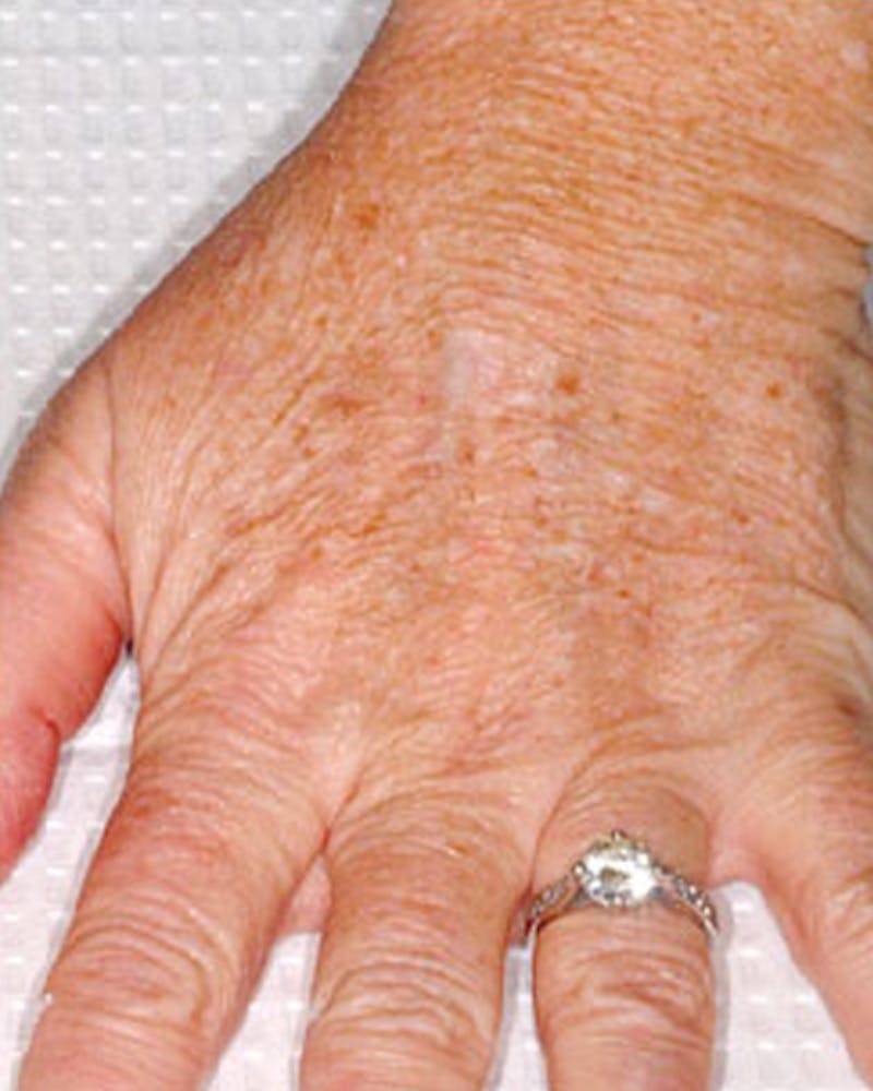 Fraxel Before & After Gallery - Patient 149370 - Image 1