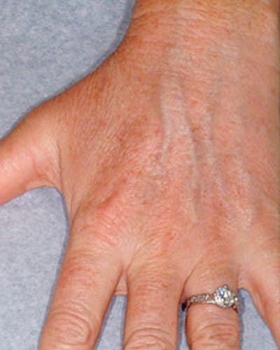 Fraxel Before & After Gallery - Patient 149370 - Image 2