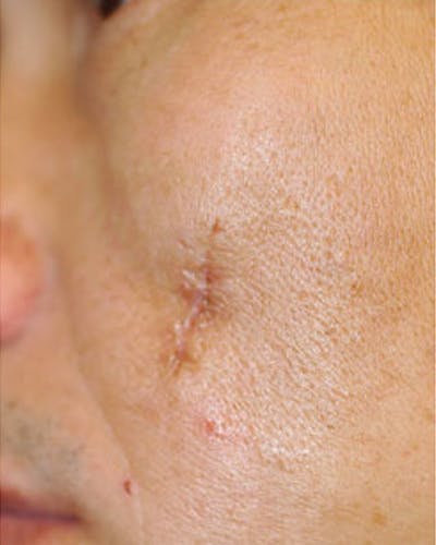 Fraxel Before & After Gallery - Patient 414151 - Image 1