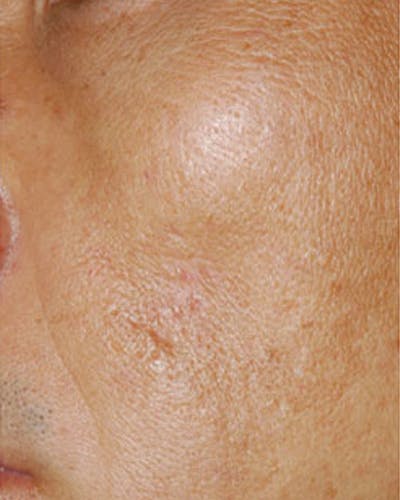 Fraxel Before & After Gallery - Patient 414151 - Image 2