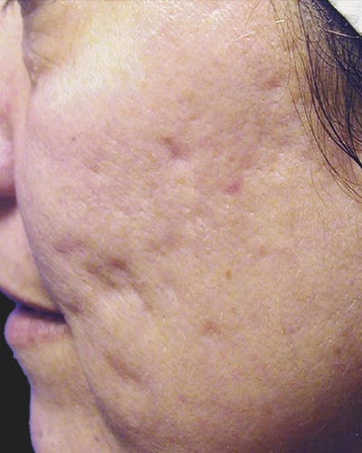 Fraxel Before & After Gallery - Patient 118756 - Image 1