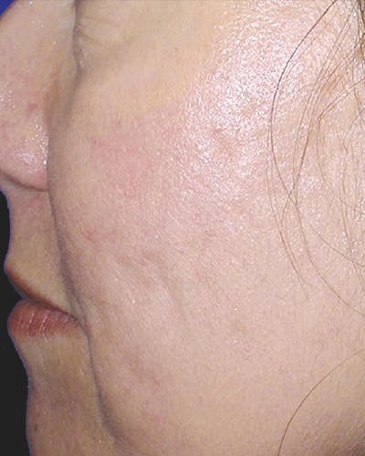 Fraxel Before & After Gallery - Patient 118756 - Image 2