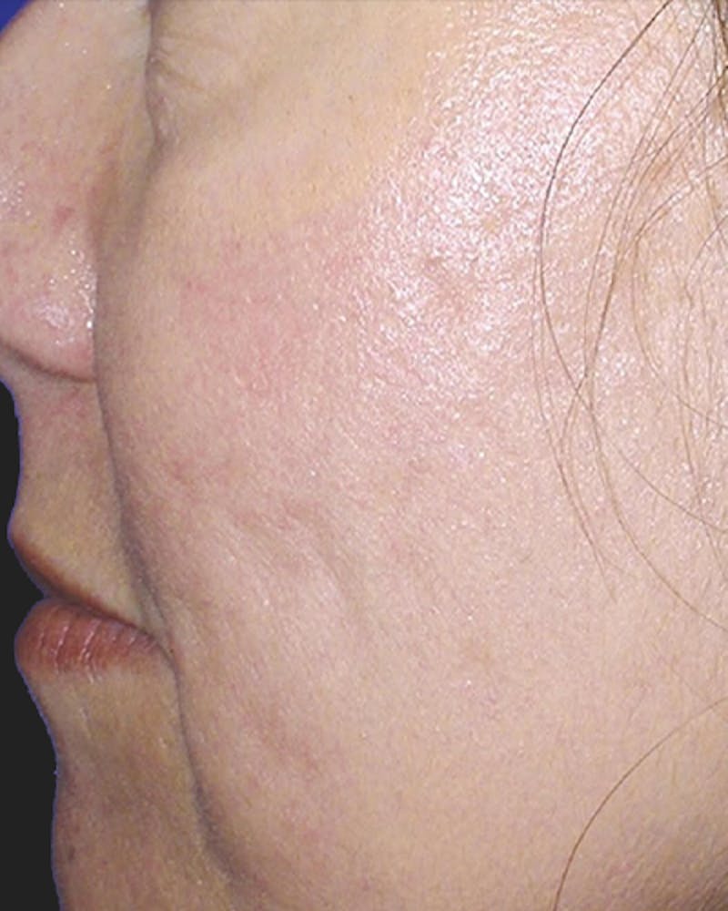 Fraxel Before & After Gallery - Patient 118756 - Image 2