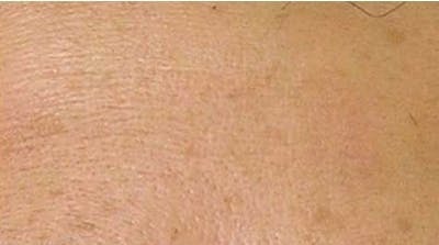 Hydrafacial Before & After Gallery - Patient 247608 - Image 1