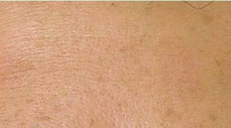 Hydrafacial Before & After Gallery - Patient 247608 - Image 1