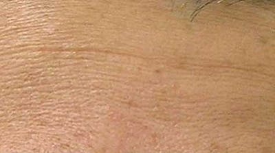 Hydrafacial Before & After Gallery - Patient 247608 - Image 2