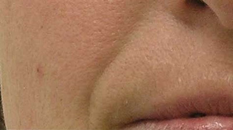 Hydrafacial Before & After Gallery - Patient 237038 - Image 1