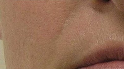 Hydrafacial Before & After Gallery - Patient 237038 - Image 2