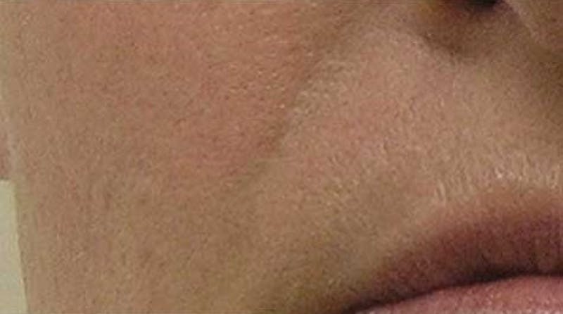 Hydrafacial Before & After Gallery - Patient 237038 - Image 2