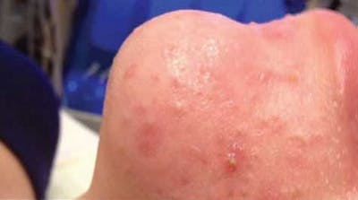 Hydrafacial Before & After Gallery - Patient 427471 - Image 1