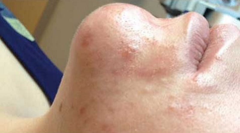 Hydrafacial Before & After Gallery - Patient 427471 - Image 2