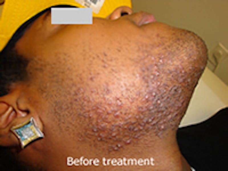Ingrown Hair Treatment Before & After Gallery - Patient 835341 - Image 1