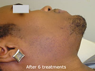 Ingrown Hair Treatment Before & After Gallery - Patient 835341 - Image 2