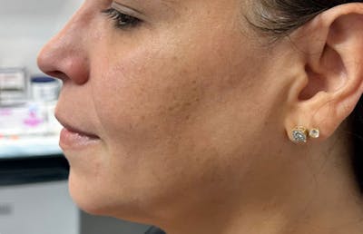 Jawline Enhacement Before & After Gallery - Patient 972977 - Image 1