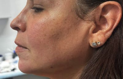 Jawline Enhacement Before & After Gallery - Patient 972977 - Image 2