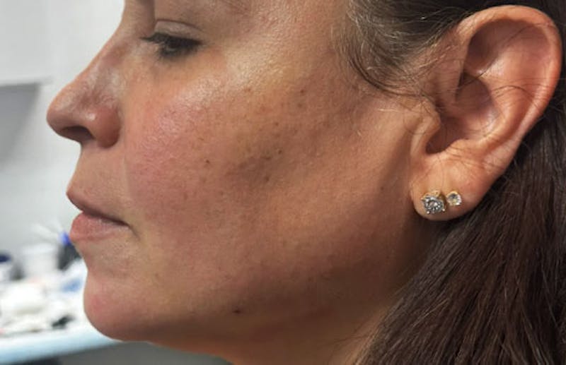 Jawline Enhacement Before & After Gallery - Patient 972977 - Image 2