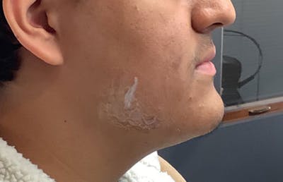 Jawline Enhacement Before & After Gallery - Patient 138842 - Image 1