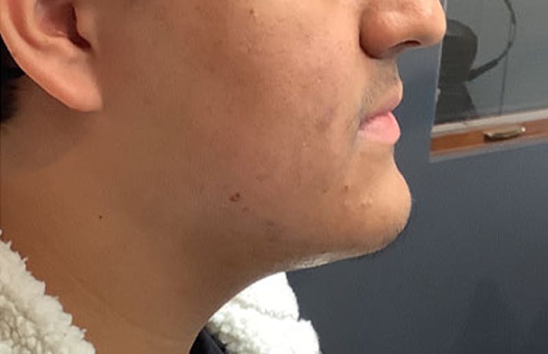 Jawline Enhacement Before & After Gallery - Patient 138842 - Image 2